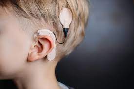 Implant cochléaires aux oreilles d'un enfant